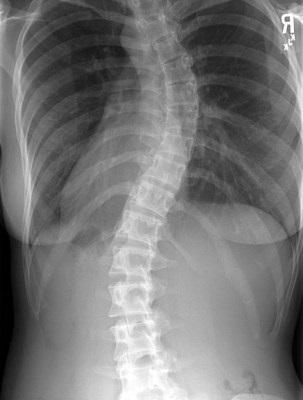 Scoliosis